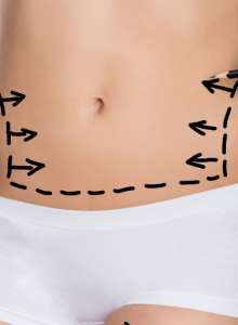 abdominoplastia precio