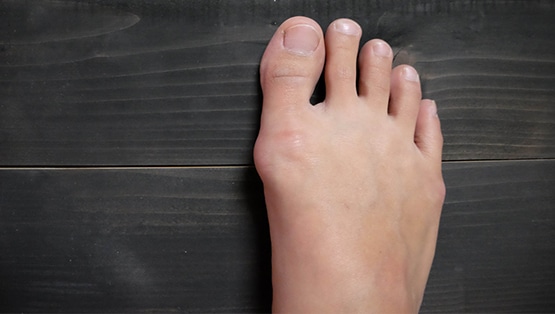 Hallux valgus cirugía Túnez