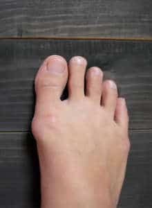 Hallux valgus cirugía