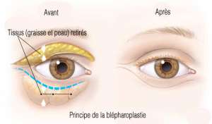 blefaroplastia antes y despues