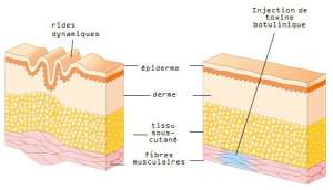 precio inyecciones botox