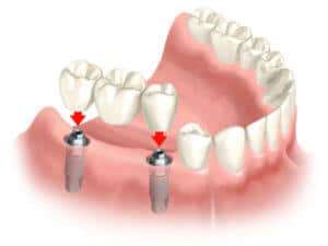 implantes dentales precios