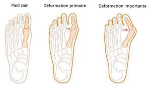 hallux valgus pie