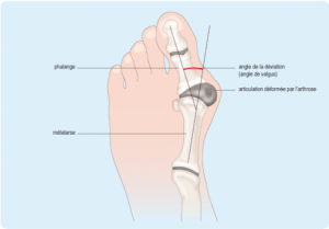 corrector hallux valgus