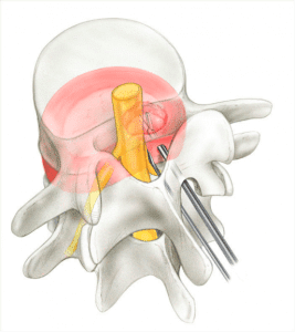 operacion hernia discal