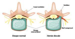 hernia discal lumbar operacion