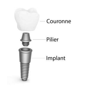 cuanto cuesta un implante dental