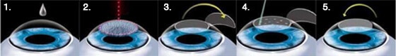 lasik surgery