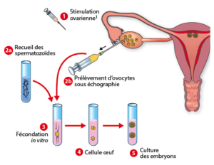 inseminación artificial y fecundación in vitro