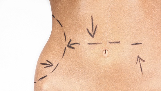 abdominoplastie tunisie