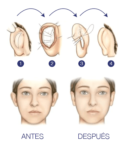 Otoplastia Que Es: La Cirugía Estética De Cambiar La Forma De Las Orejas