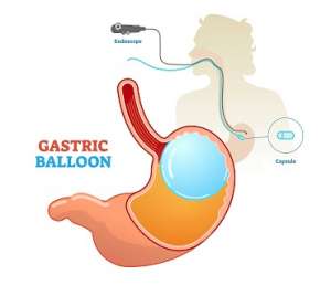 globo gastrico precio