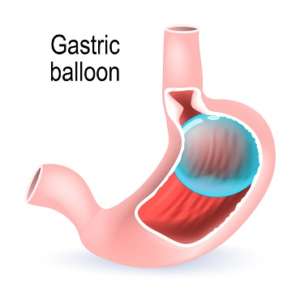 operacion del globo gastrico