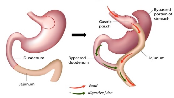 Bypass gastrico precio