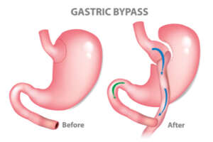 bypass gastrico precio