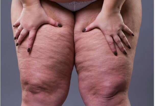 lipoedema