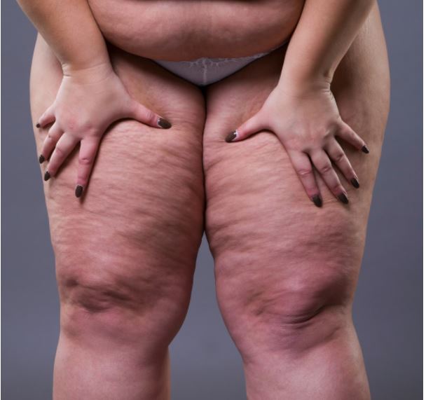 lipoedema